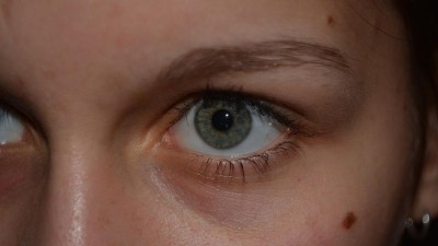 V rámci dne melanomu si můžete nechat dnes a zítra zkontrolovat svá znaménka lékařem přímo v Atriu Palace Pardubice