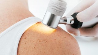 Nechte si bez objednání a zdarma zkontrolovat znaménko či podezřelou pihu