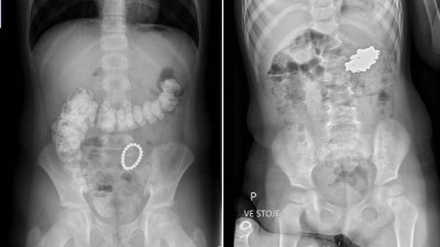 Děti, co spolkly magnetické kuličky, byly operovány. Nedávejte malým dětem tuto hračku, podívejte se, co jim v břiše udělá